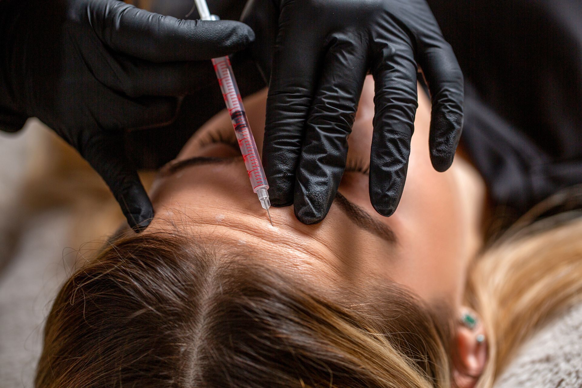 Eine Frau bekommt eine Botox-Injektion in die Stirn.