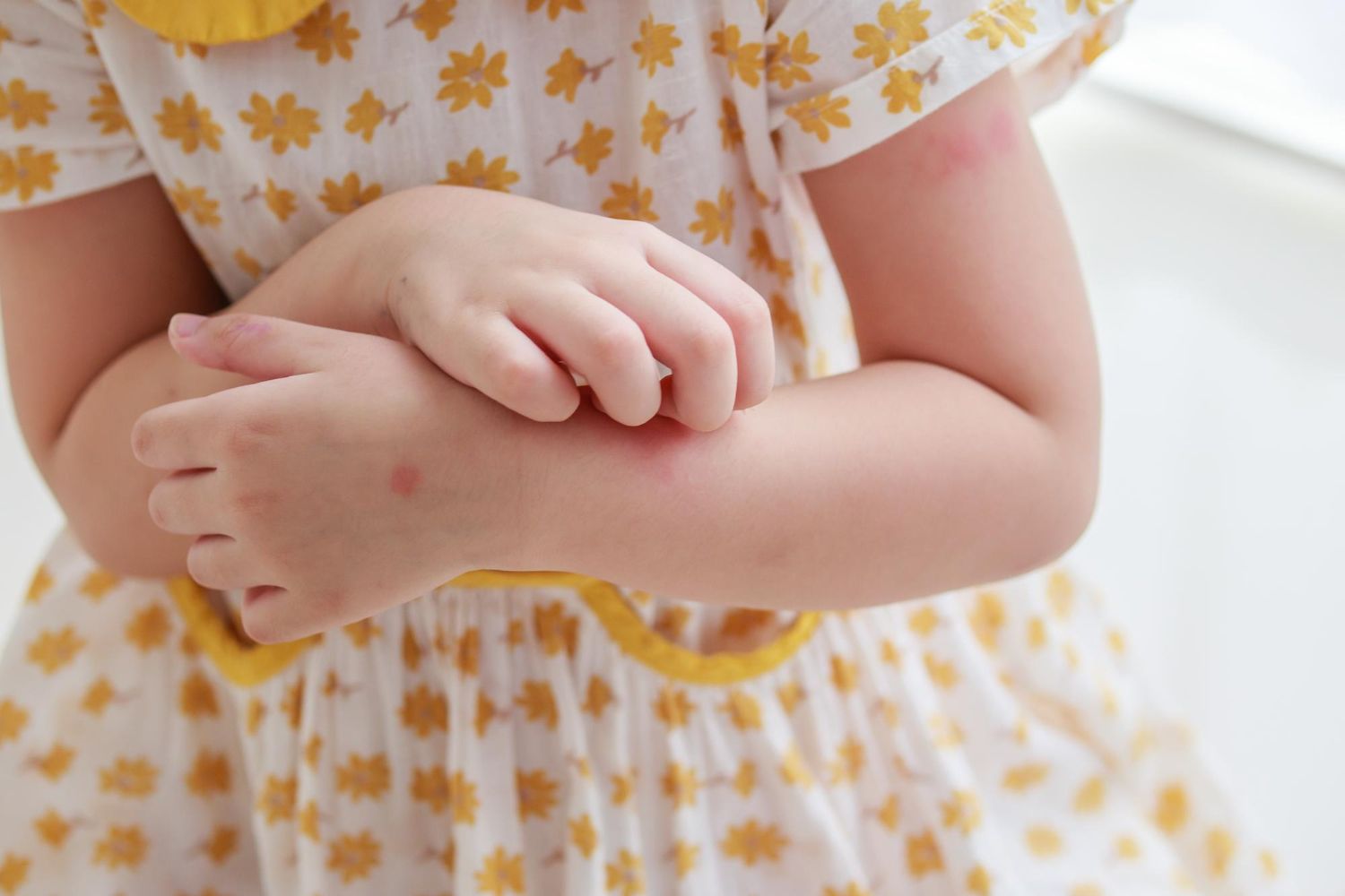eczema treatment