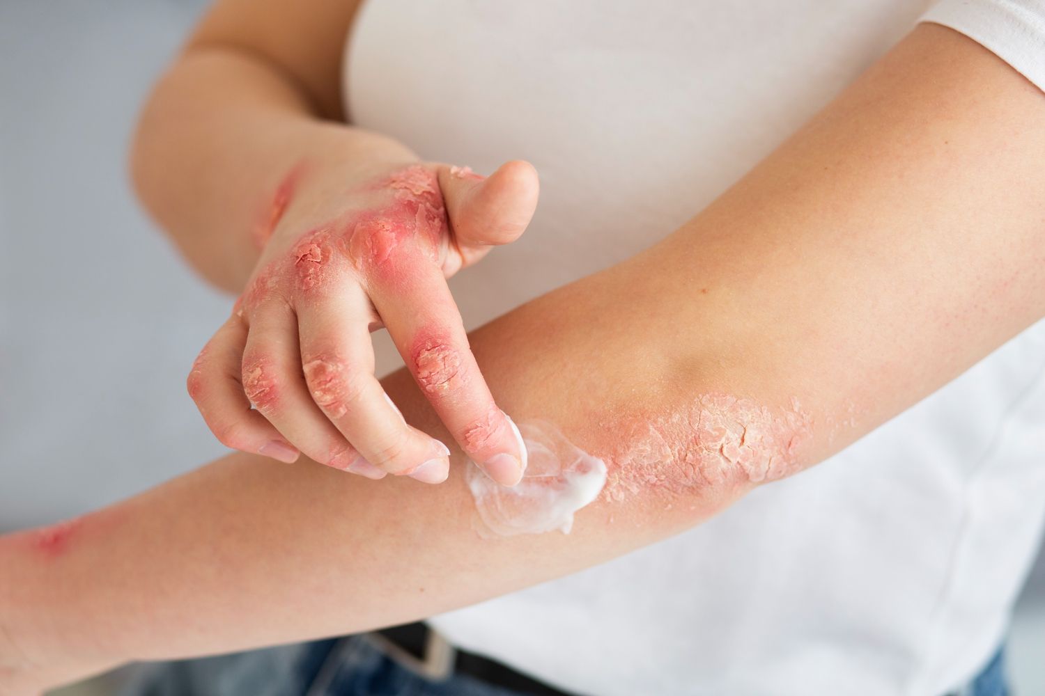 hives treatment