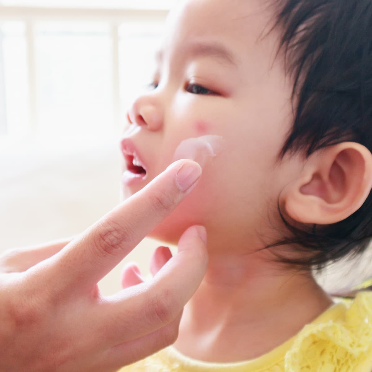 Eczema and hives treatment