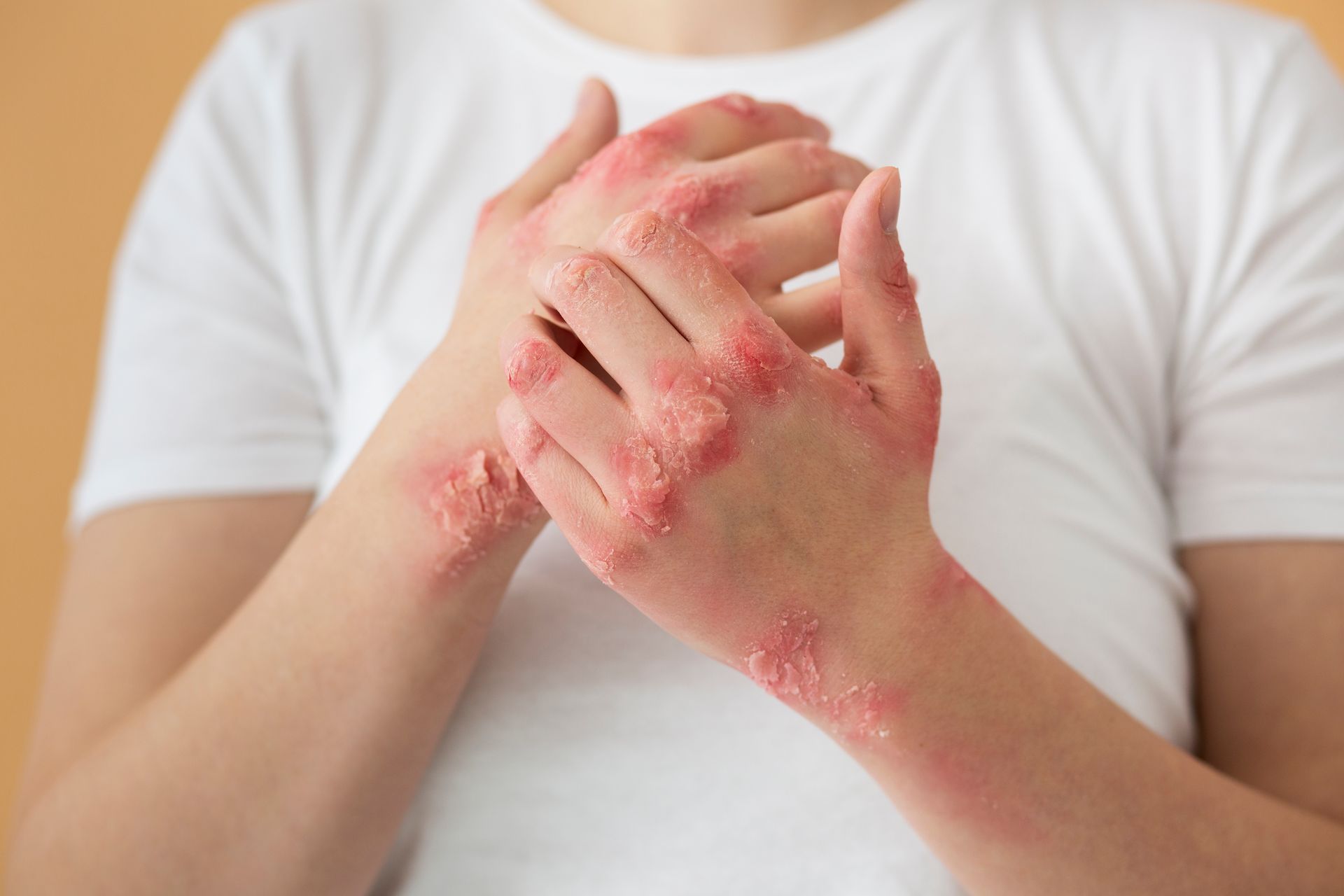 hands patient suffering from psoriasis 