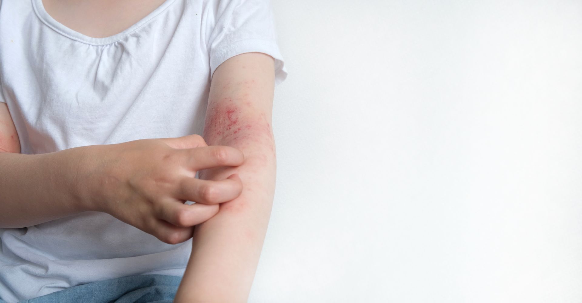 chronic urticaria biologic treatment