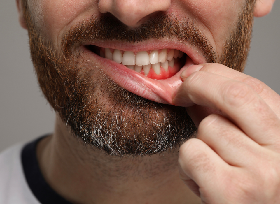 Close-up of a bearded man pulling down his lower lip to reveal teeth and gums