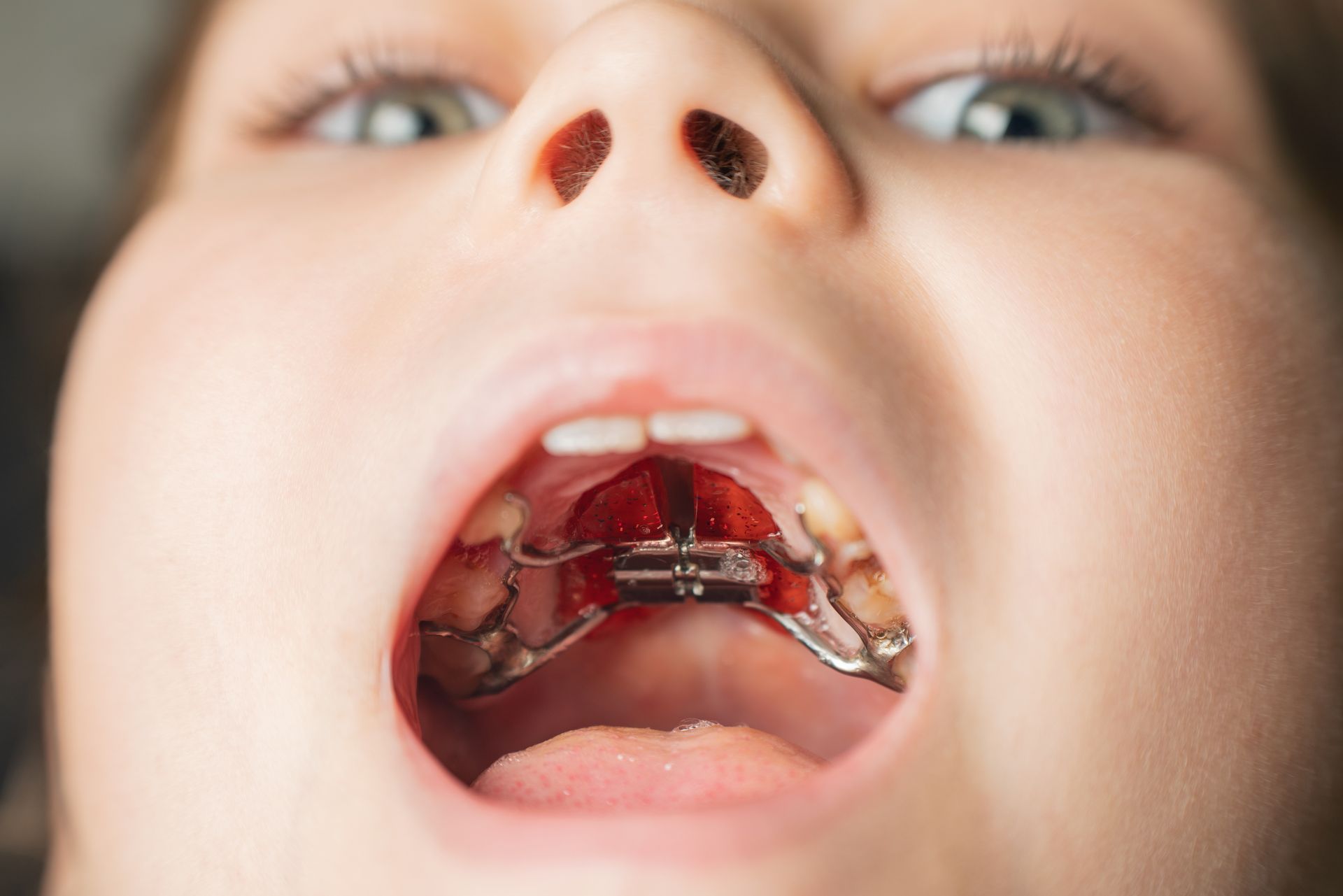 Close-up of a child's open mouth showing red braces and upper teeth from below