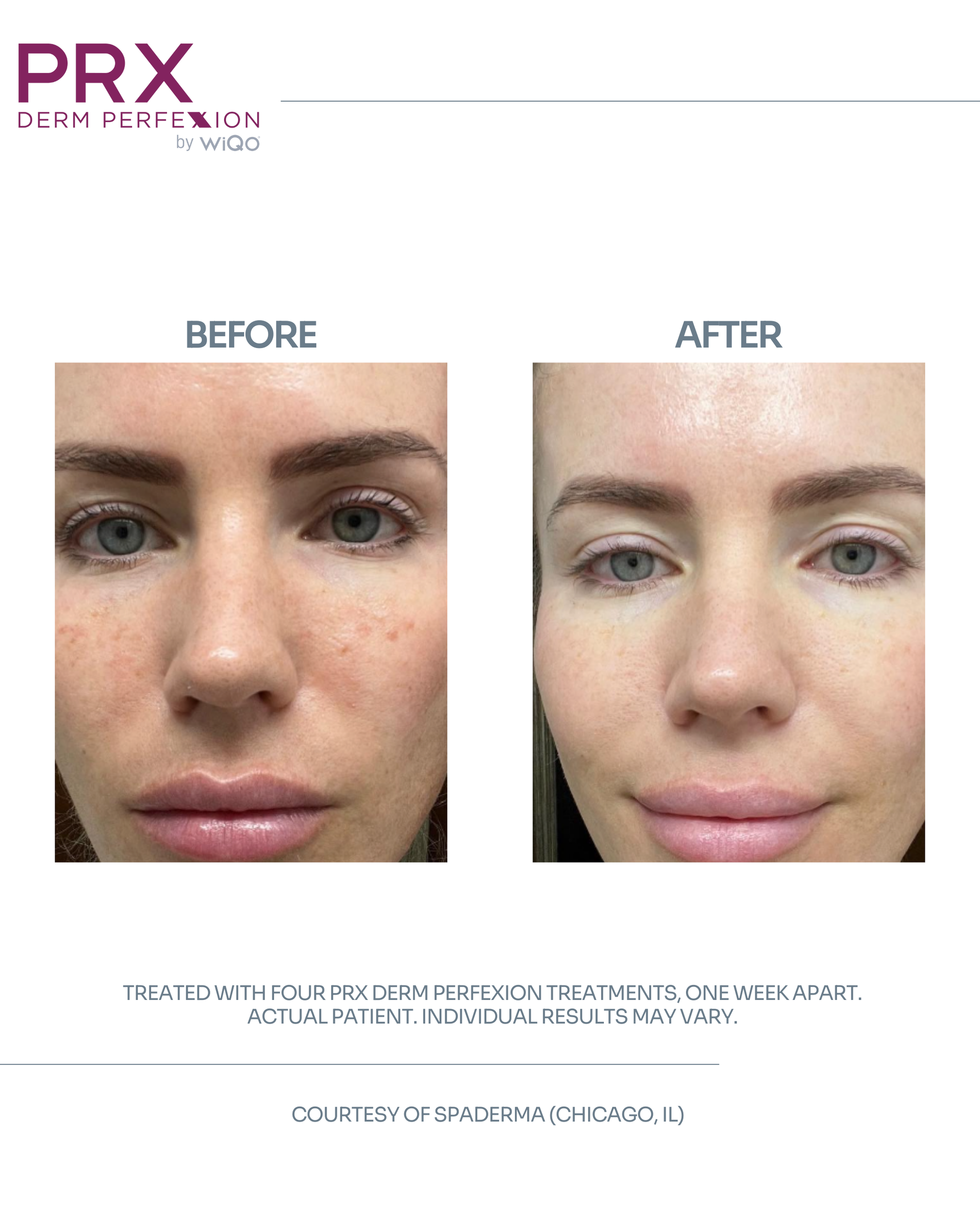 Actual MAX MD patient before and after four PRX Derm Perfexion treatments