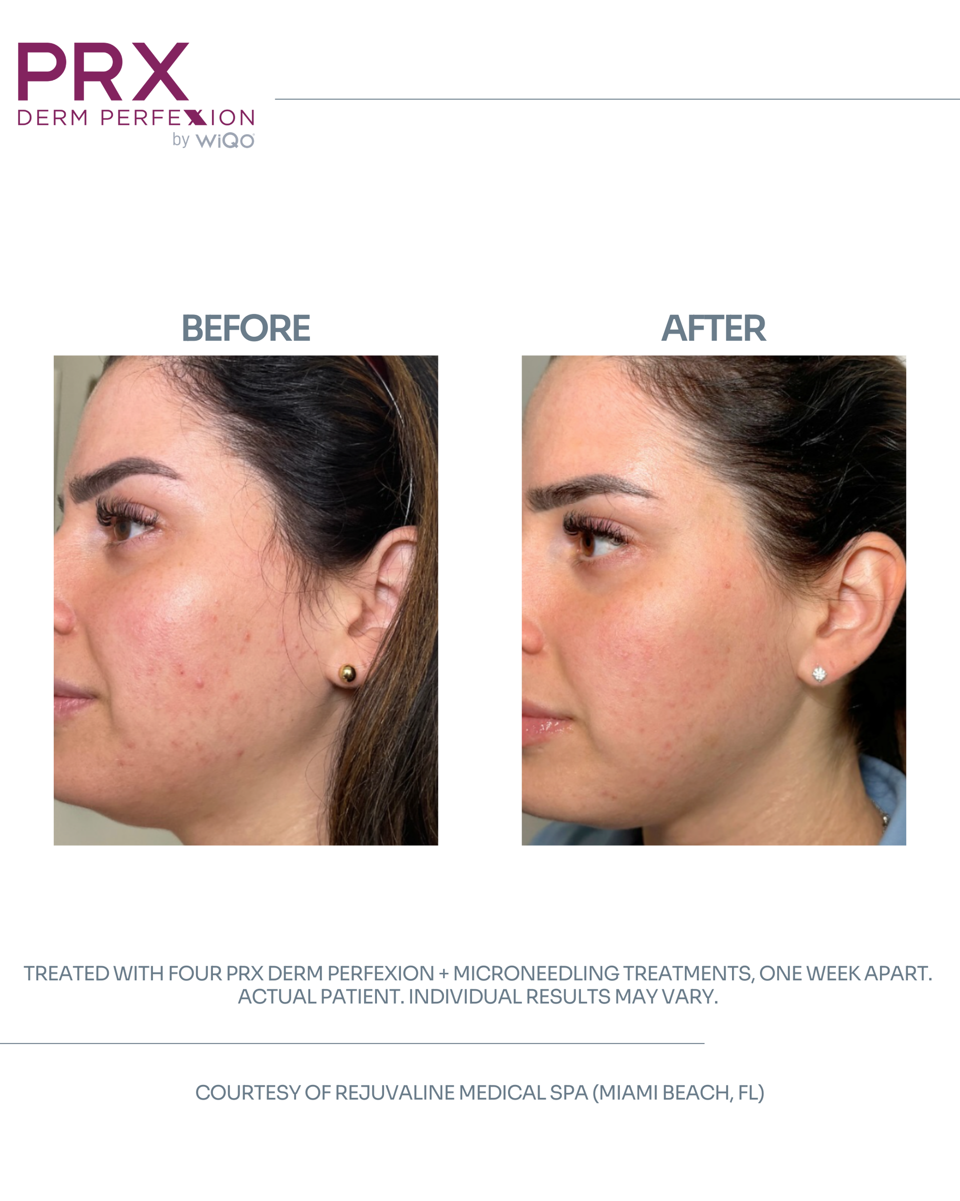 Actual MAX MD patient before and after PRX Derm Perfexion with microneedling