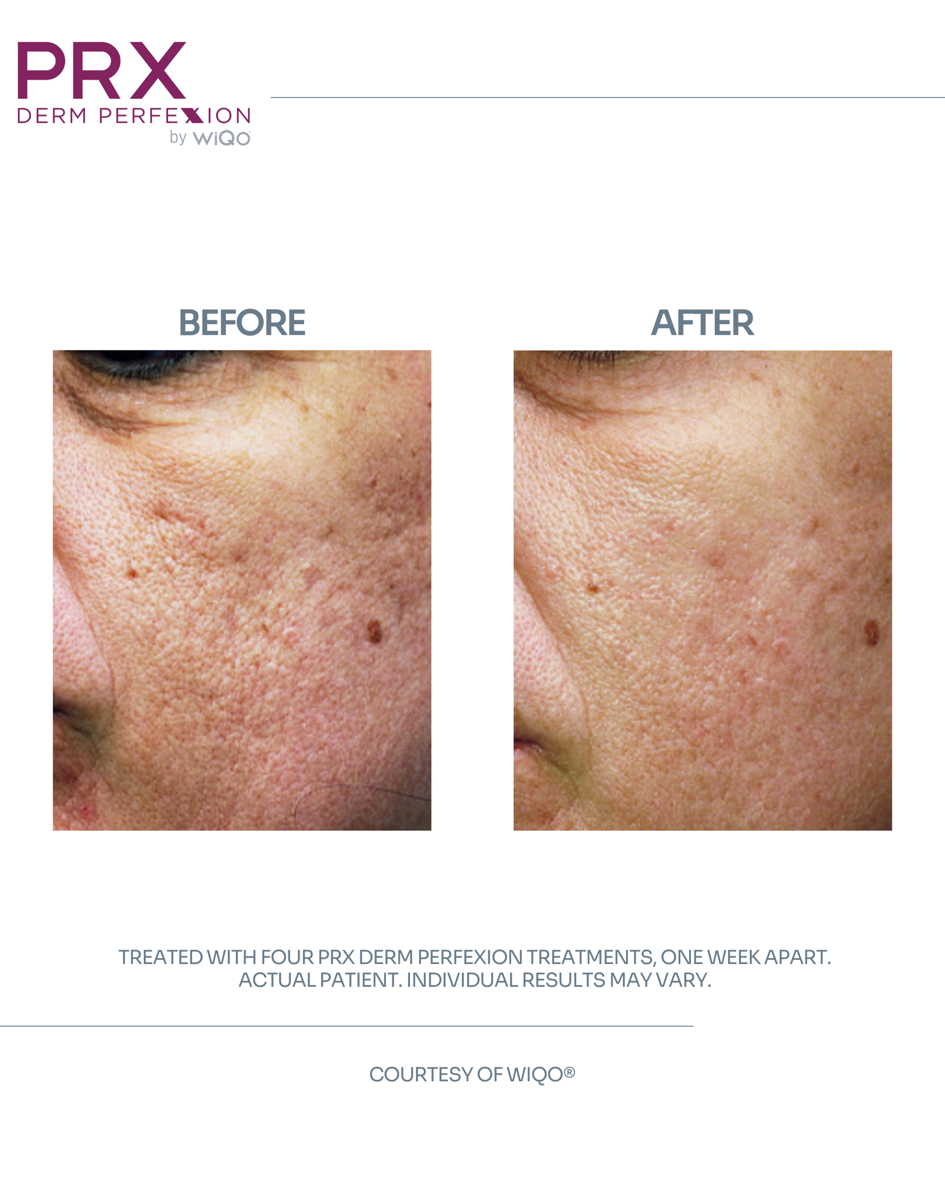 Actual MAX MD patient before and after four PRX Derm Perfexion treatments for skin texture