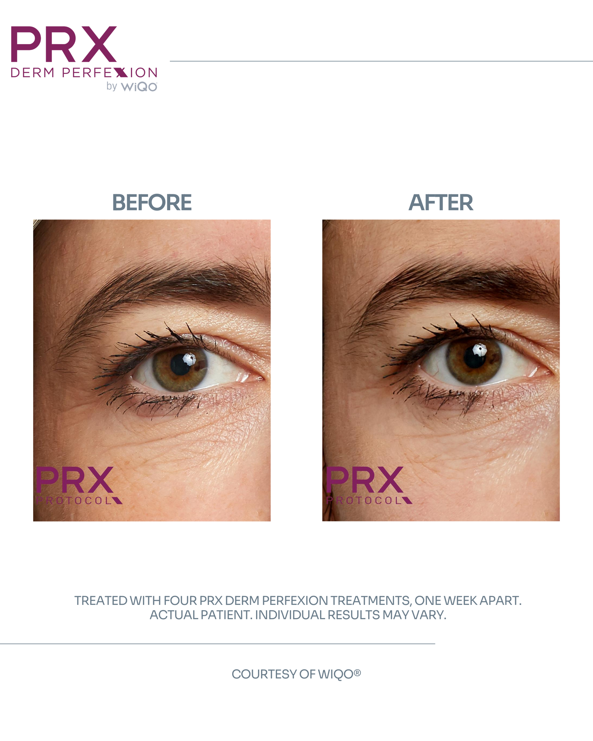 Actual MAX MD patient before and after four PRX Derm Perfexion treatments around the eyes