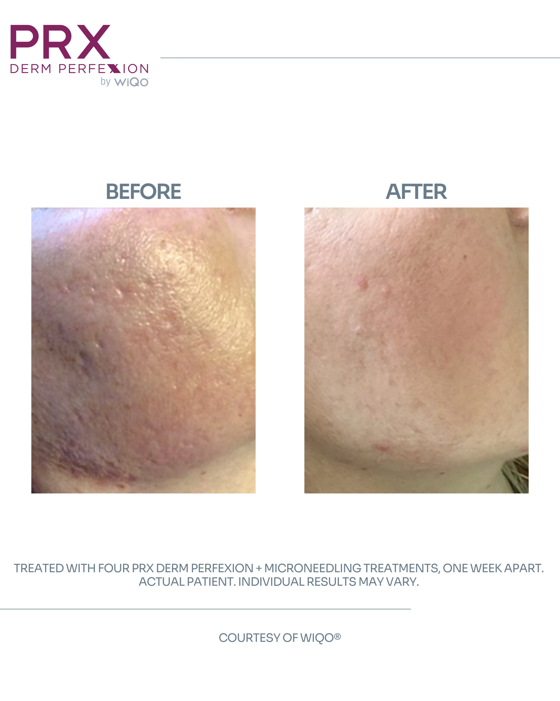 Actual MAX MD patient before and after PRX Derm Perfexion with microneedling for skin tone
