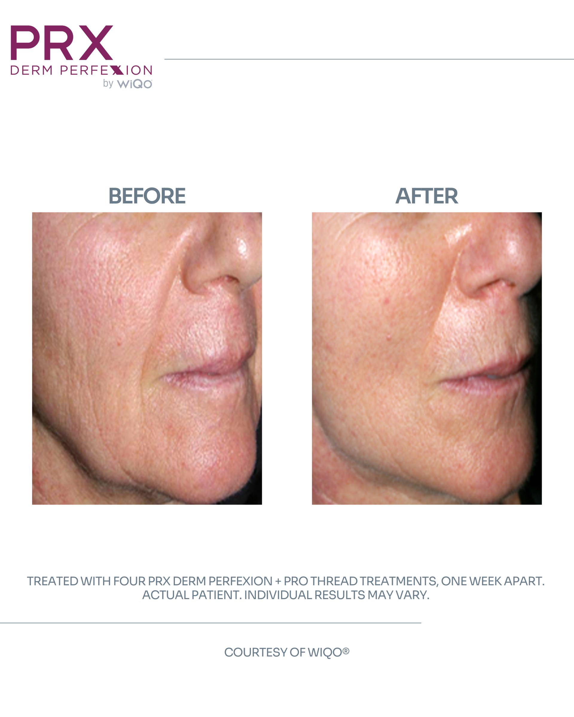 Actual MAX MD patient before and after PRX Derm Perfexion with PDO threads