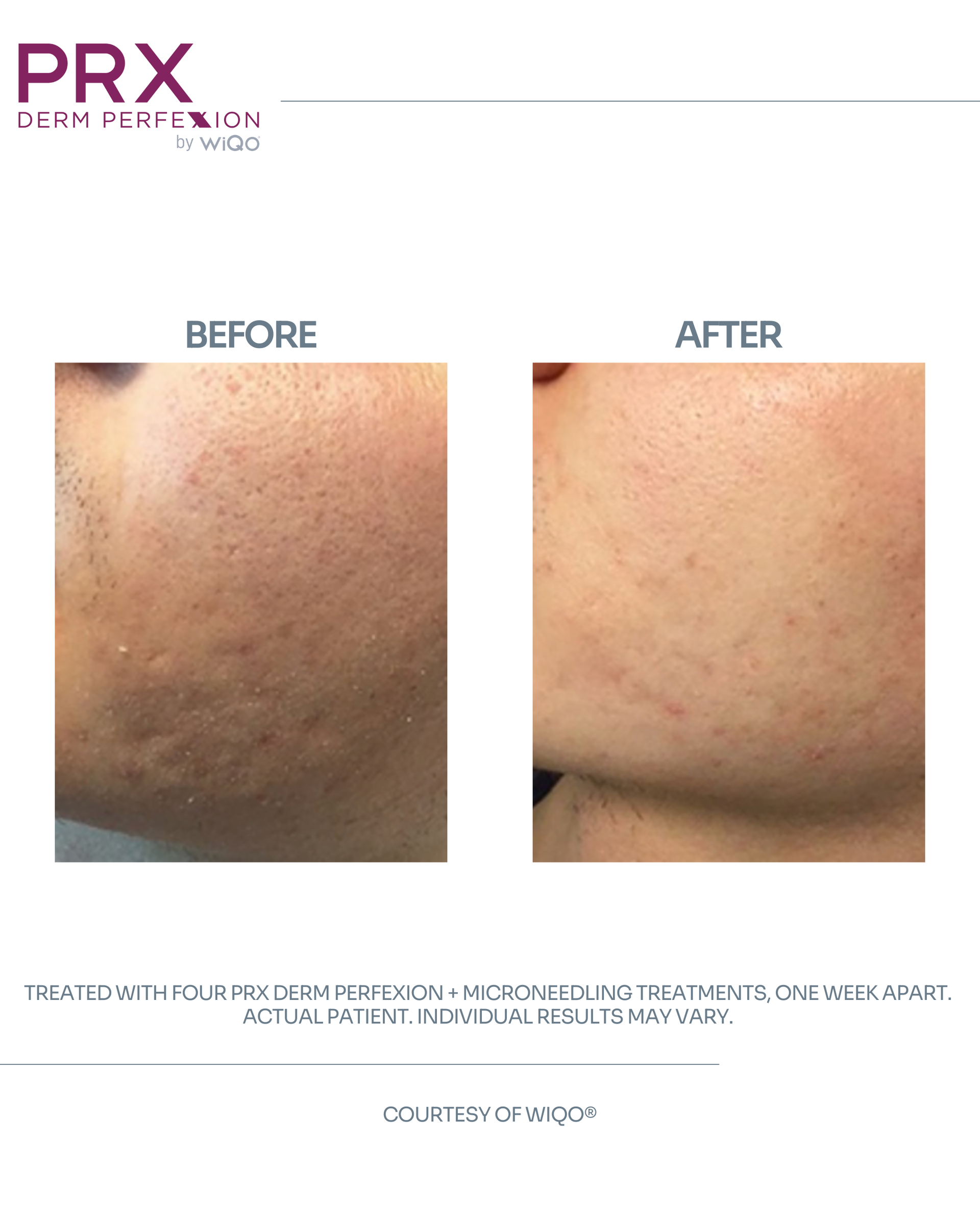 Actual MAX MD patient before and after PRX Derm Perfexion with microneedling for skin clarity