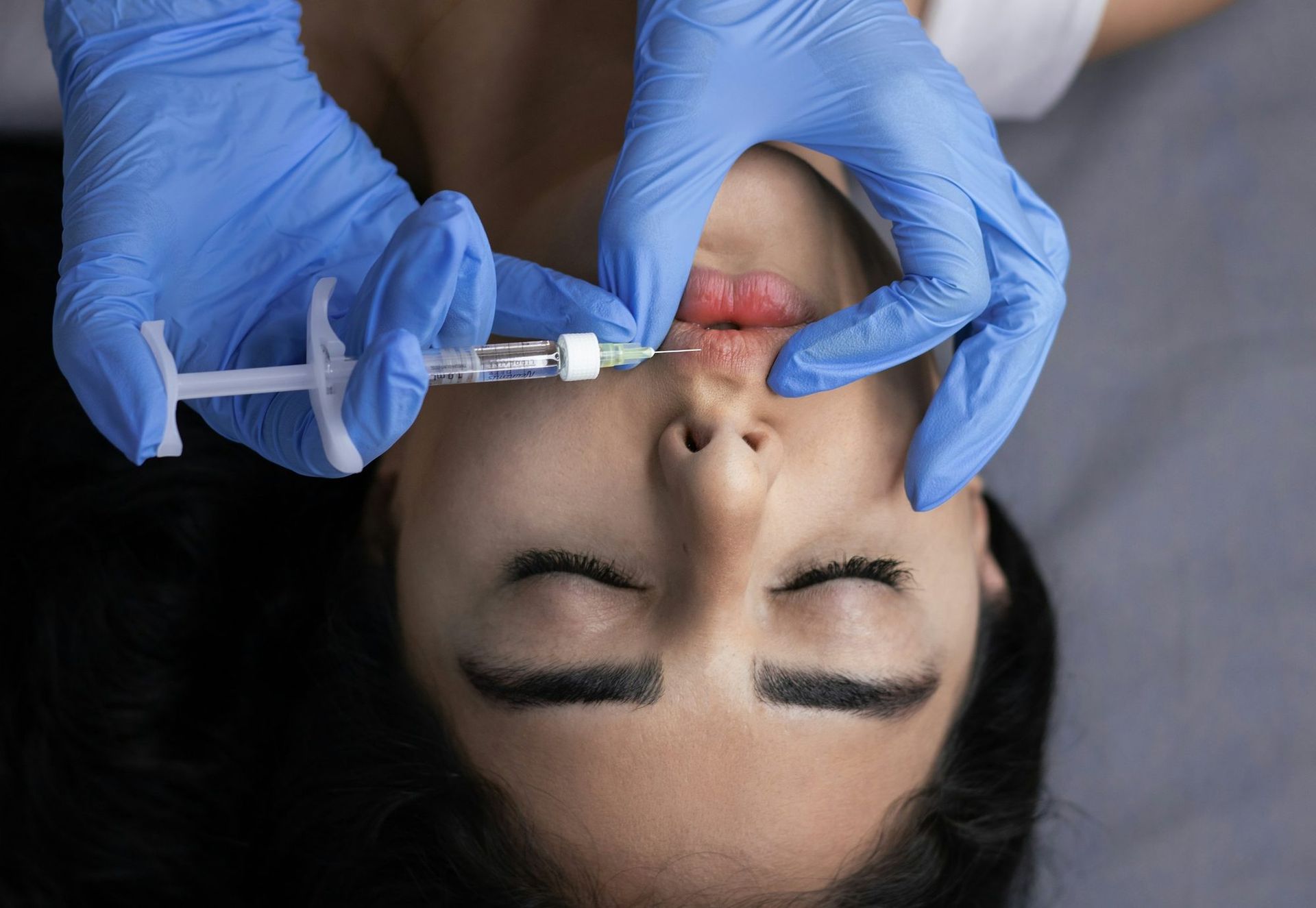 Lip filler being placed with a fine needle at MAX MD Medical Aesthetics and Wellness in Garden City, NY