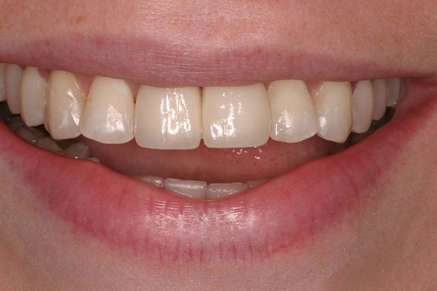 Veneers After