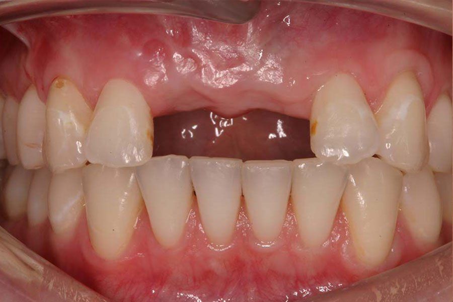 Veneers Before