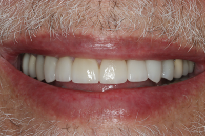A close up of a man 's mouth with a beard and white teeth.