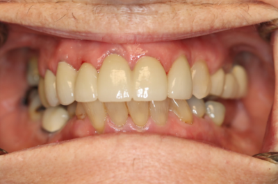 A close up of a man 's teeth with a few missing teeth.