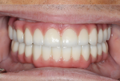 A close up of a person 's teeth with white teeth.