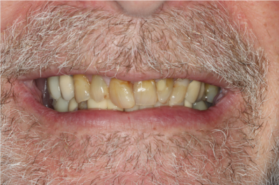 A close up of a man 's teeth with a beard.