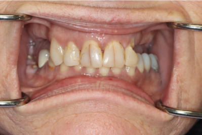 A close up of a person 's mouth with braces on their teeth.