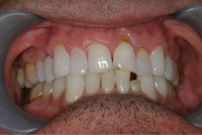 A close up of a man 's teeth with a missing tooth.