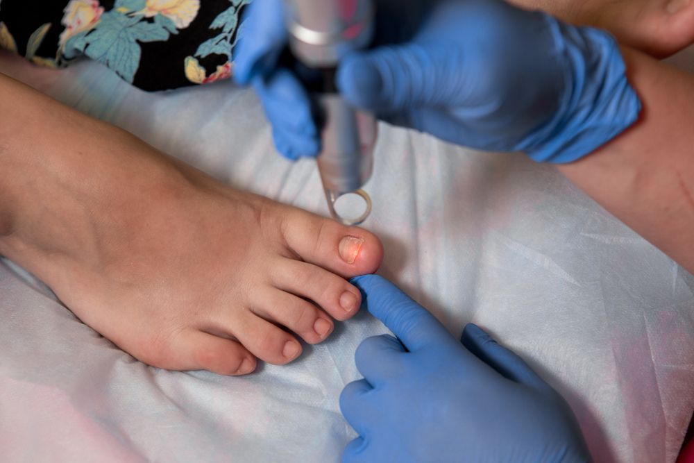 Toenail Fungus Treatment With Foot Laser at Laser Nail — General Foot & Nail Clinic in Forster, NSW