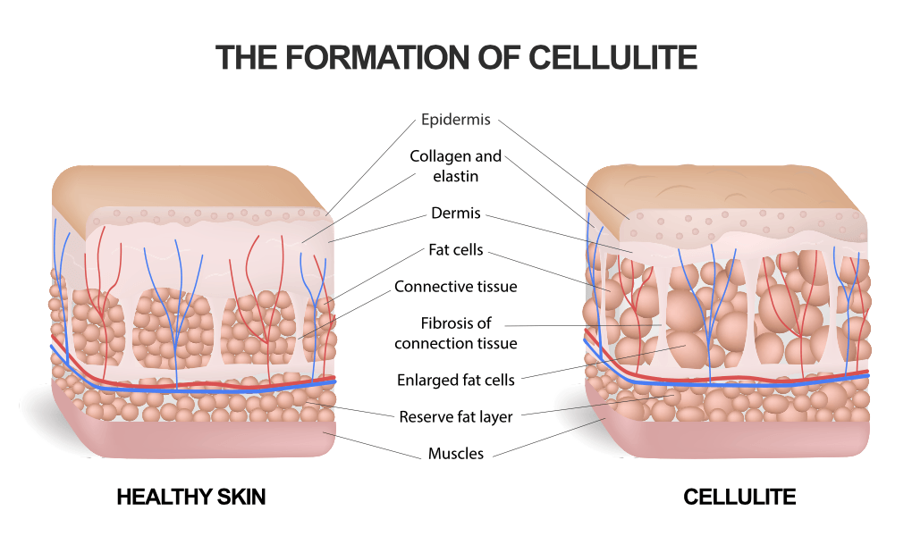 A diagram showing the formation of cellulite and healthy skin