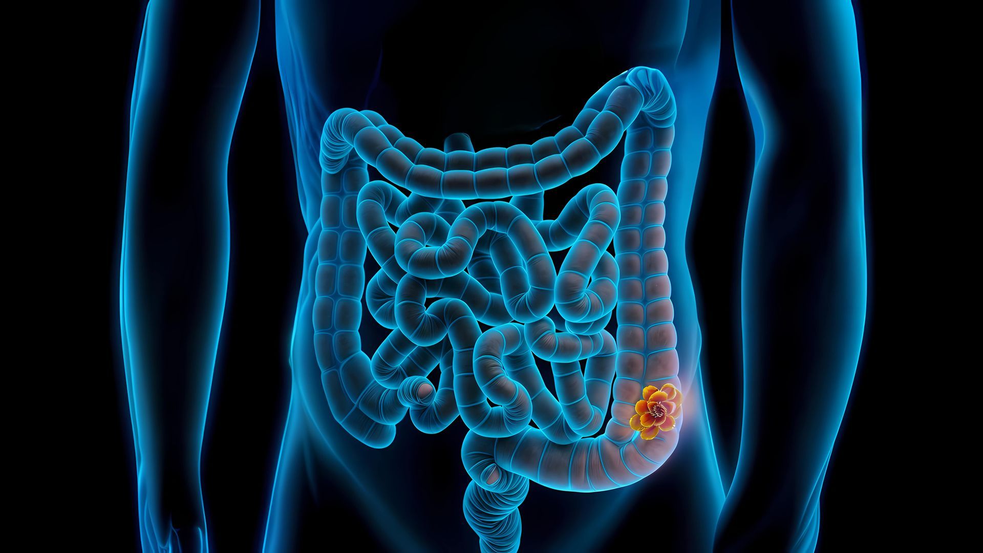 Ilustração anatômica 3D do corpo destacando o intestino e reto em laranja, representando Câncer do Reto e do Intestino
