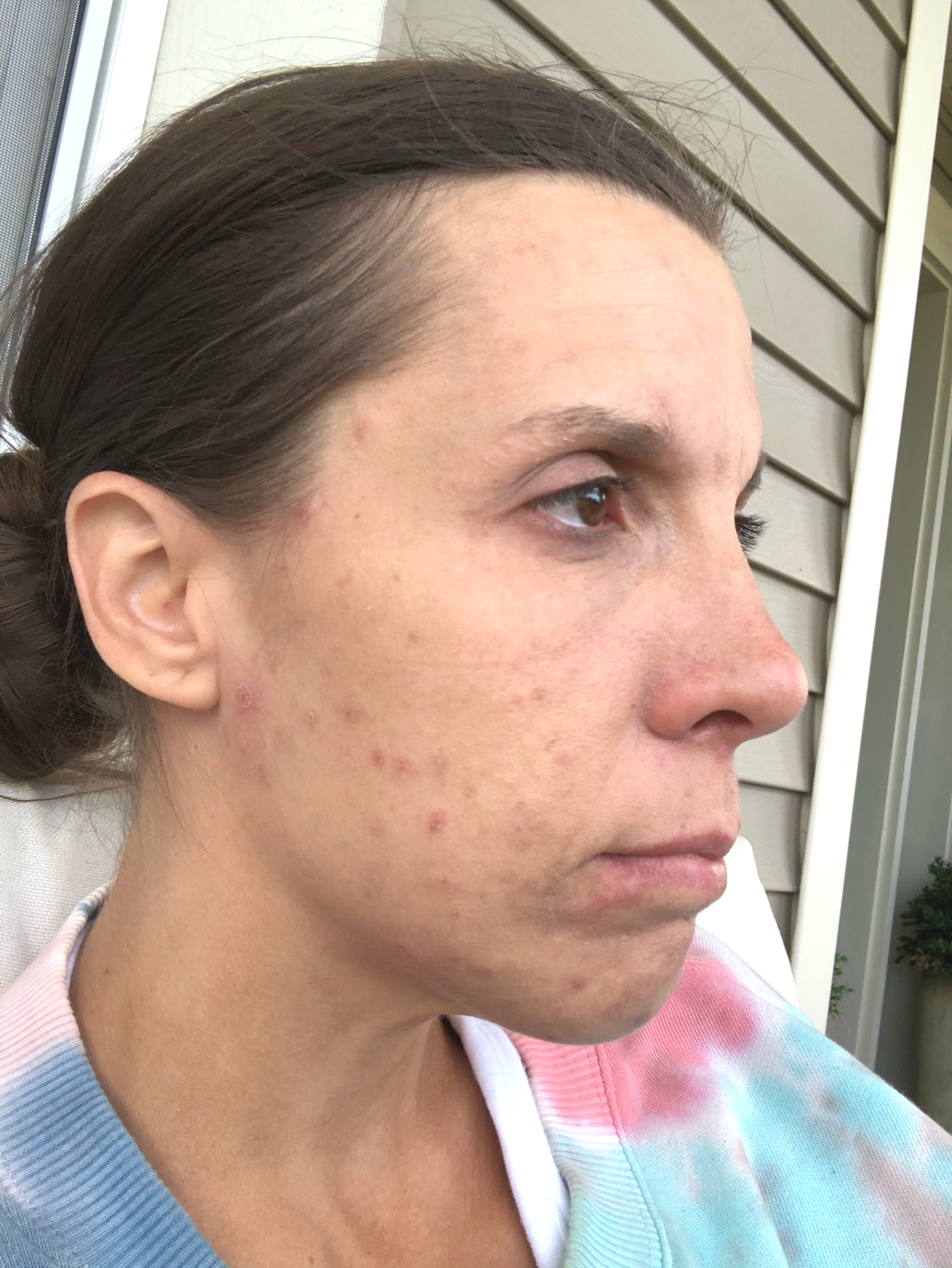 amy outside can only see right side of her face covered in Babesia marks hair pulled back