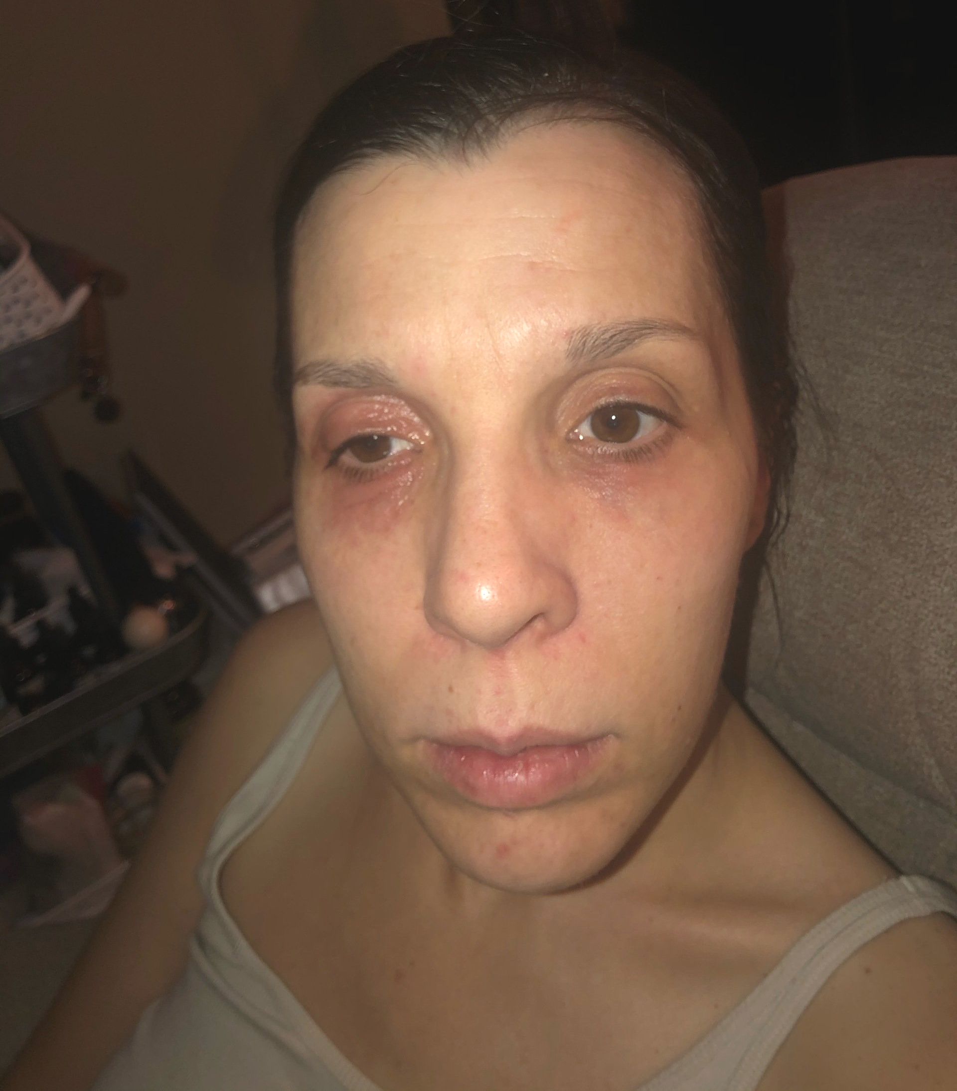 close up of amy's face sitting in recliner with mast cell reaction all over her eyes . No expression.