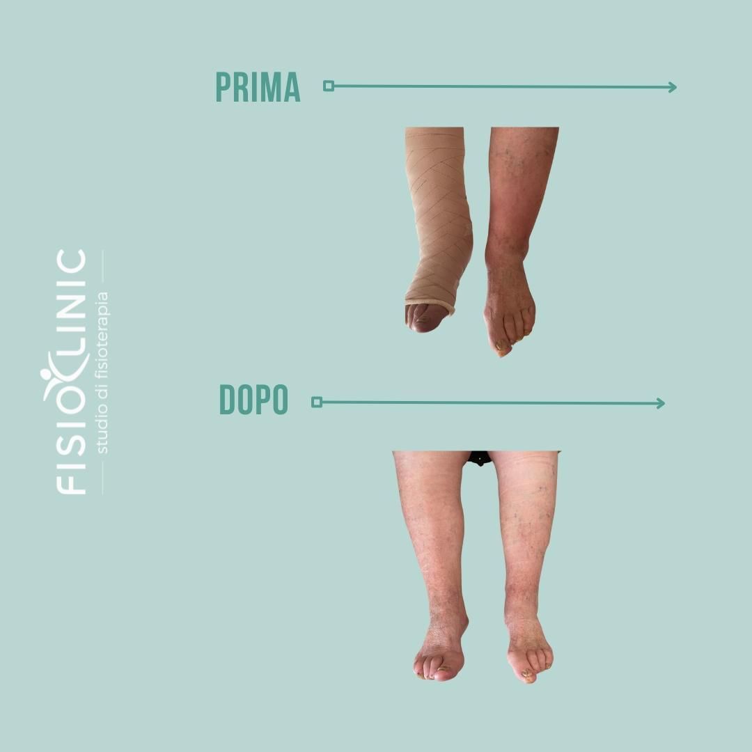 Confronto delle gambe prima e dopo il trattamento; gonfiore ridotto.
