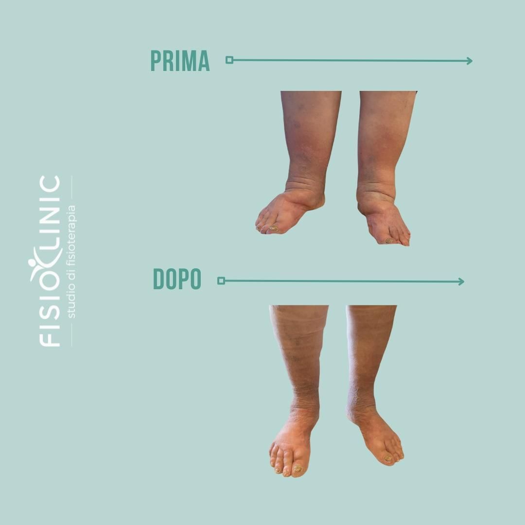 Gambe prima e dopo che mostrano una riduzione del gonfiore. Le gambe