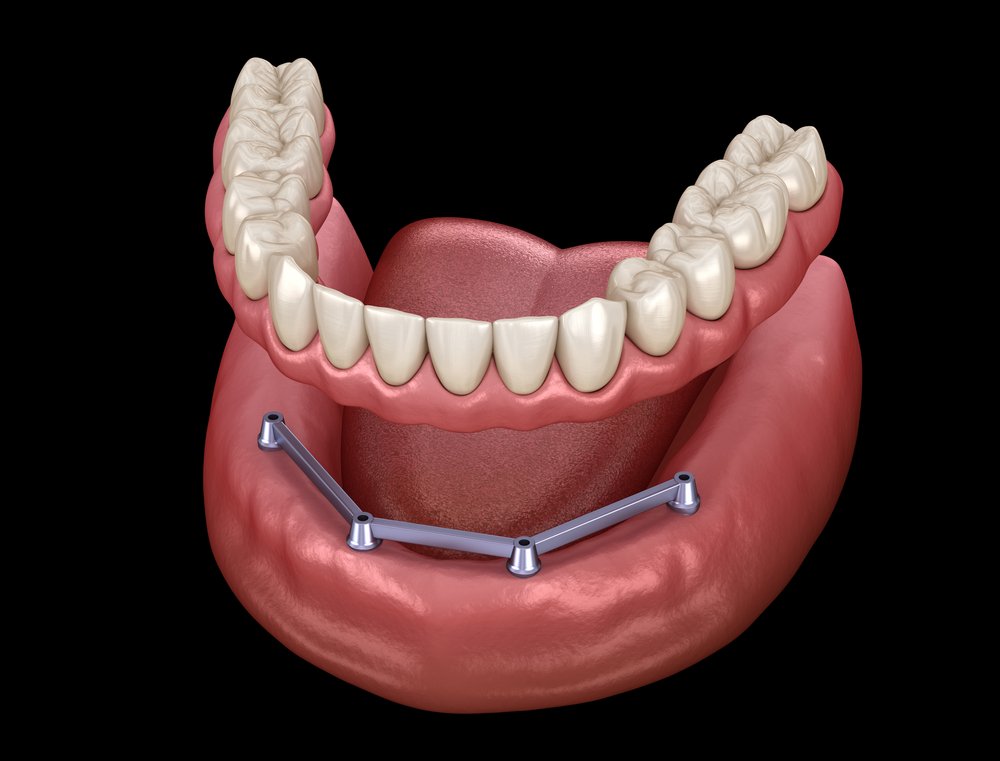 Dental Implants Stabilize Your Dentures and Your Smile With Implants