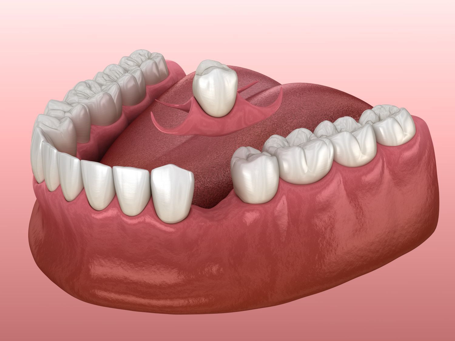 Illustration of lower dental arches with missing teeth and a single upper tooth implant/removable denture piece
