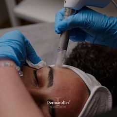 Person receiving a dermaroller treatment on their forehead, performed by a gloved hand.