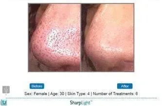 Comparison of a nose before and after skin rejuvenation treatment, showing reduced pore size.