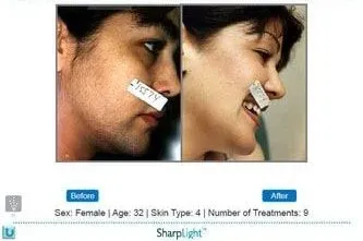 Before and after facial hair reduction. A woman, age 32, with dark skin, post-9 treatments.
