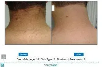 Comparison of a neck with hair before (left) and after (right) hair reduction treatment.