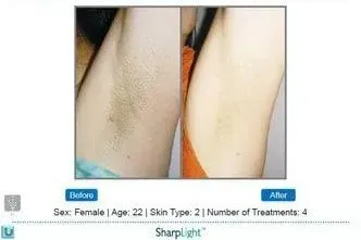 Hair reduction comparison: axilla (armpit) before/after 4 treatments.
