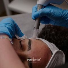 Person receiving a dermaroller treatment on their forehead, performed by a gloved hand.