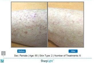 Comparison of arm skin before and after skin rejuvenation treatments.