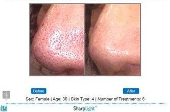 Comparison of a nose before and after skin rejuvenation treatment, showing reduced pore size.