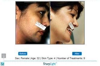 Before and after facial hair reduction. A woman, age 32, with dark skin, post-9 treatments.