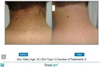 Comparison of a neck with hair before (left) and after (right) hair reduction treatment.