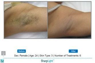 Before and after axilla hair reduction treatment: armpit with dark hair, then after 6 treatments with less hair.
