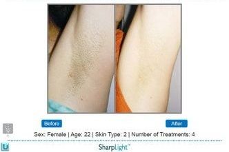 Hair reduction comparison: axilla (armpit) before/after 4 treatments.