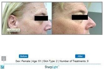 Skin rejuvenation comparison: Before and after photos of a face, showing reduced wrinkles. Includes text indicating the person is female, 51 years old, and has had 9 treatments.