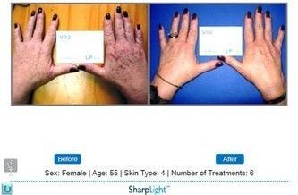 Before and after hand photos showing skin rejuvenation. Includes patient age/sex, skin type and number of treatments.