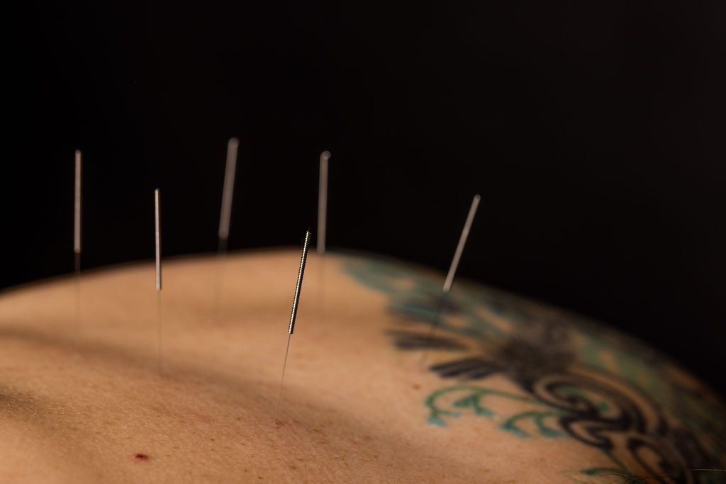 Acupuncture needles inserted into a person’s skin near a tattoo