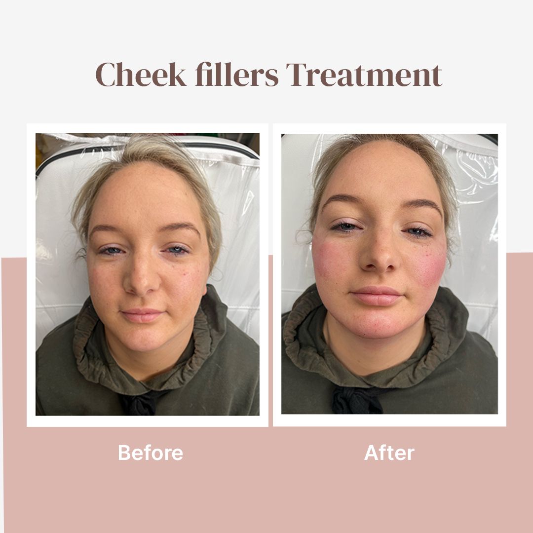 Check fillers treatment before-and-after face comparison with subtle cheek and lip changes