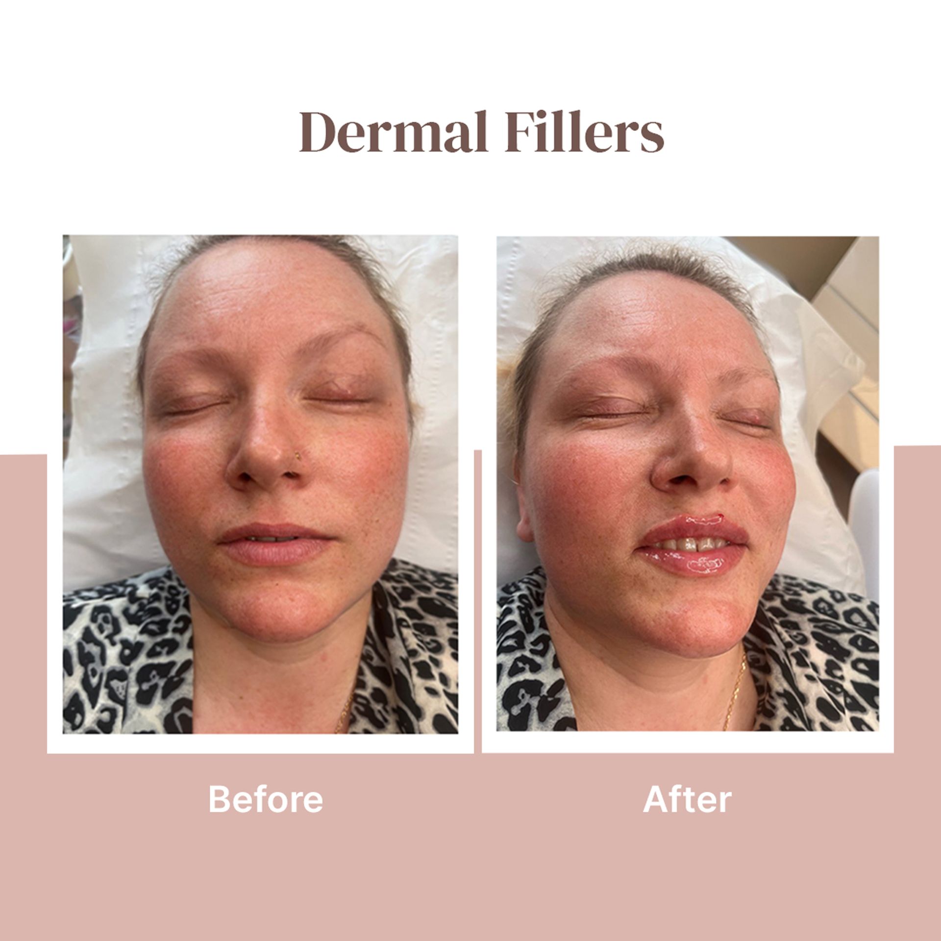 Dermal fillers before-and-after comparison of a face, showing fuller lips and cheeks after treatment